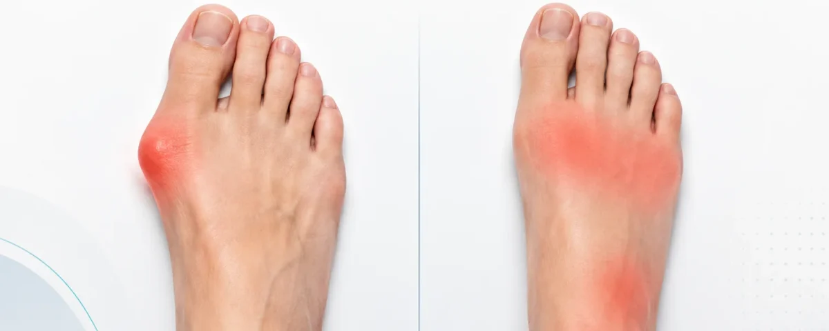 Bunion vs. Regular Foot Pain