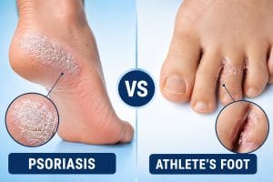 Psoriasis or Athlete’s Foot