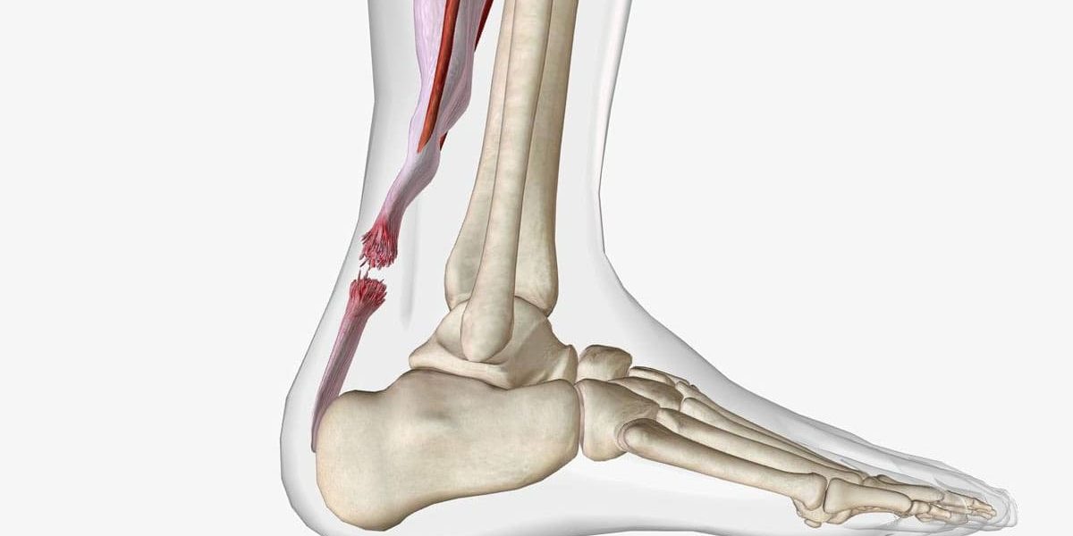 Achilles Tendonitis Treatment Mesa