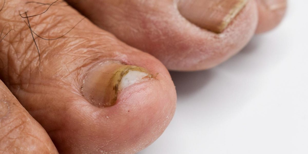 Advanced Nail Fungus Treatments Chandler