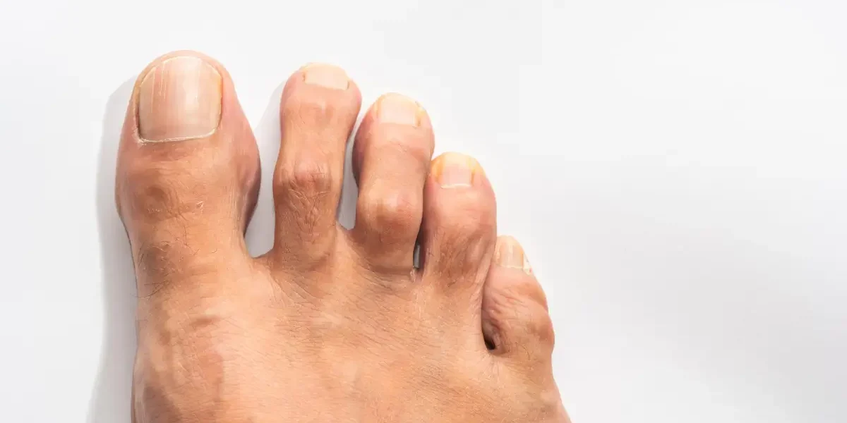 Hammer Toe Treatments in Chandler, AZ