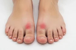 Rheumatoid Arthritis Treatment in Scottsdale for Feet